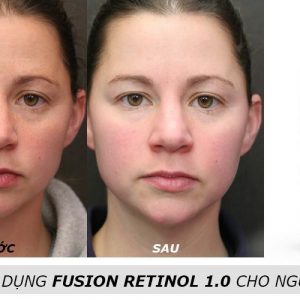 kem-tre-hoa-da-chuyen-sau-fusion-retinol-1-0-2